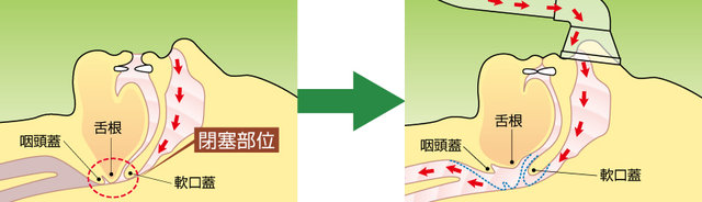 CPAP(シーパップ)-2
